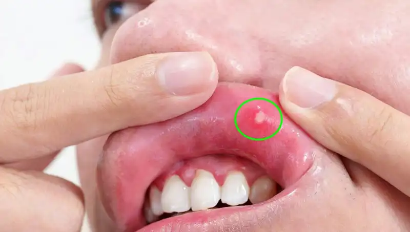 Kanser Belirtilerini Görmezden Gelen Genç Kadın, Dilini Kaybetme Riskiyle Karşılaştı