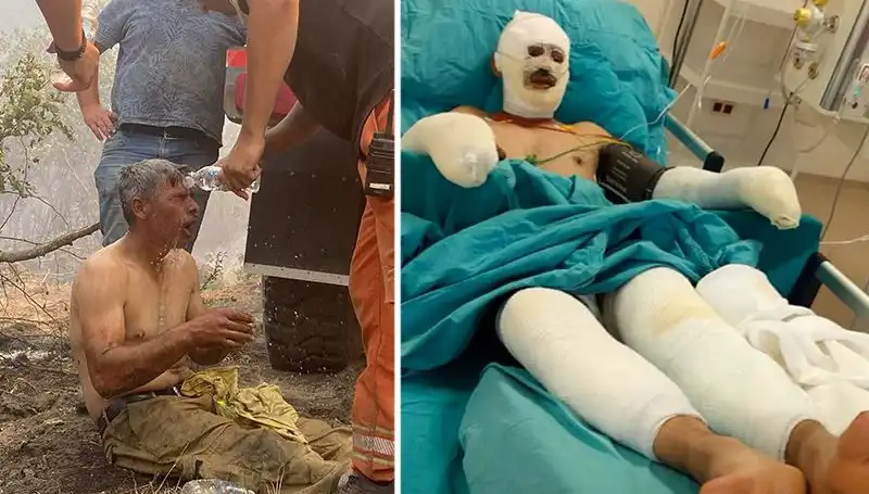 Orman İşçisinin Yanık Tedavisi Devam Ediyor: Yaşadığı Dehşet Anları